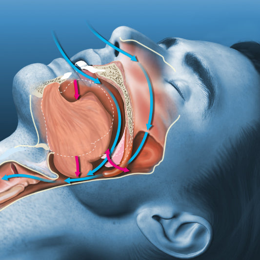 Snorkeskinne-søvnapnø